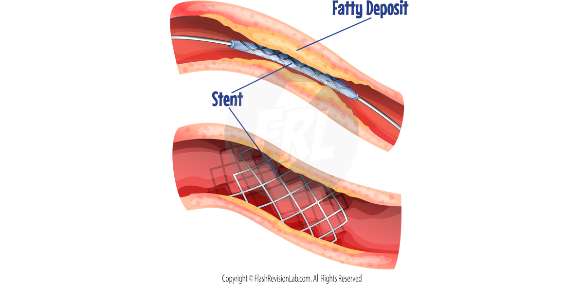 Stents